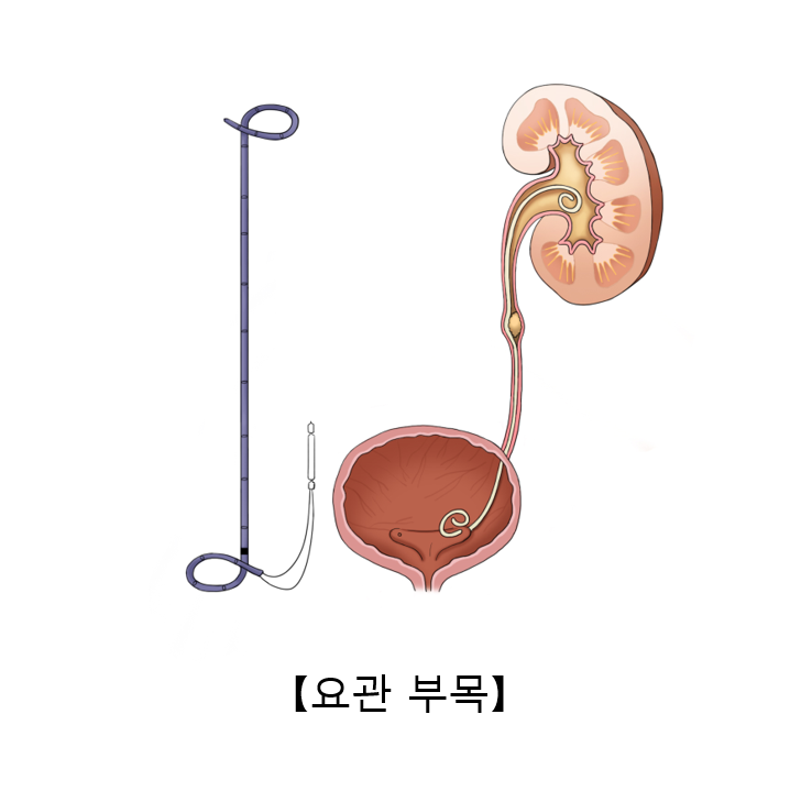 Stent 이미지