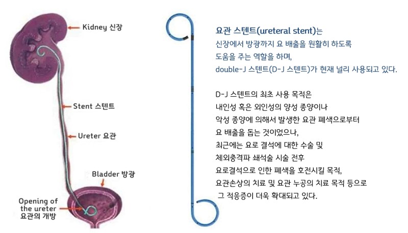 요관스텐트 설명