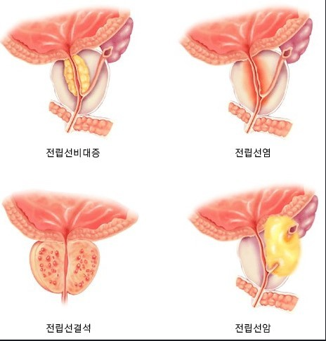 전립선암